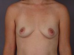 Gummy Bear Breast Implant Before and After Photo