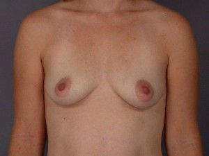 Gummy Bear Breast Implant Before and After Photo