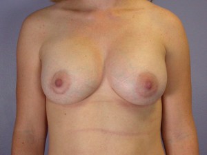 Gummy Bear Breast Implant Before and After Photo