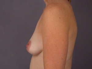 Gummy Bear Breast Implant Before and After Photo