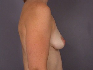 Gummy Bear Breast Implant Before and After Photo