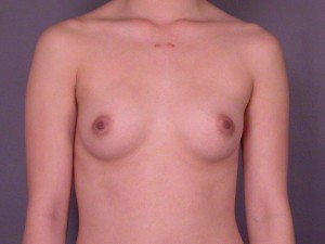 Gummy Bear Breast Implant Before and After Photo