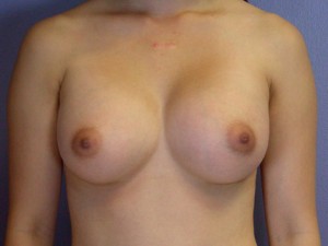 Gummy Bear Breast Implant Before and After Photo