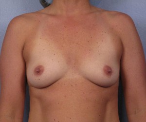 Gummy Bear Breast Implant Before and After Photo