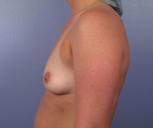 Gummy Bear Breast Implant Before and After Photo