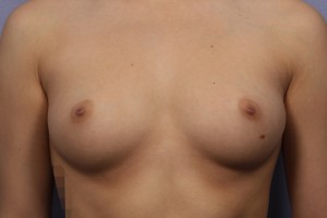 Gummy Bear Breast Implant Before and After Photo