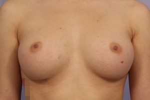 Gummy Bear Breast Implant Before and After Photo