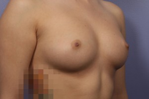 Gummy Bear Breast Implant Before and After Photo