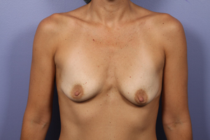 Gummy Bear Breast Implant Before and After Photo