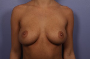 Gummy Bear Breast Implant Before and After Photo