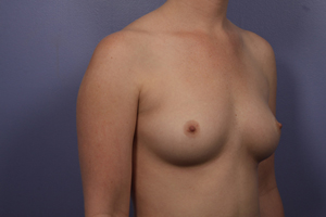 Gummy Bear Breast Implant Before and After Photo