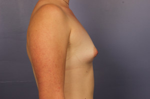 Gummy Bear Breast Implant Before and After Photo