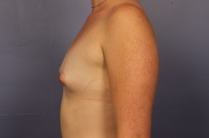 Gummy Bear Breast Implant Before and After Photo