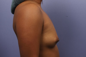 Gummy Bear Breast Implant Before and After Photo