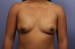 Gummy Bear Breast Implant Before and After Photo