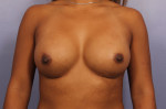 Gummy Bear Breast Implant Before and After Photo