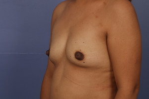 Gummy Bear Breast Implant Before and After Photo