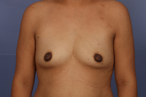 Gummy Bear Breast Implant Before and After Photo